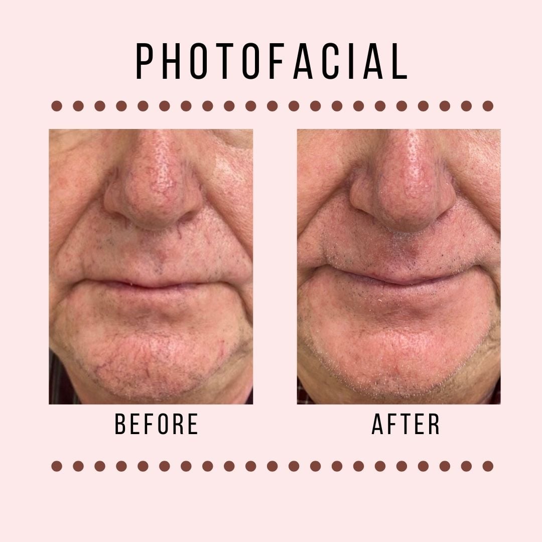 Photofacial to Clear Blood Vessel Appearance